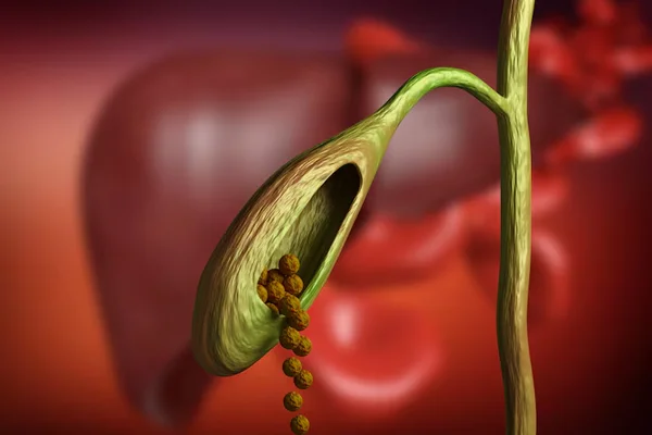 Gallbladder Stones