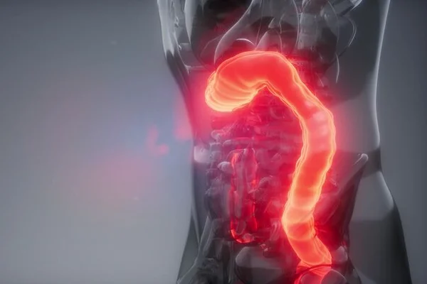 Appendicitis
